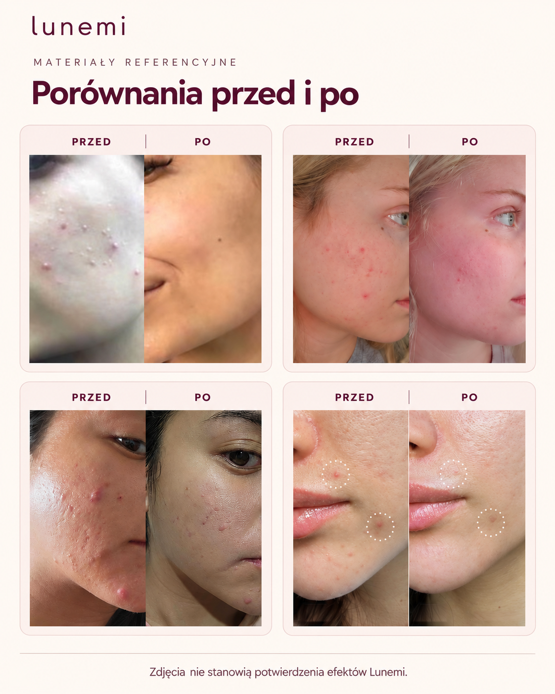 Porównania przed i po — materiały referencyjne. Zdjęcia nie stanowią potwierdzenia efektów Lunemi.